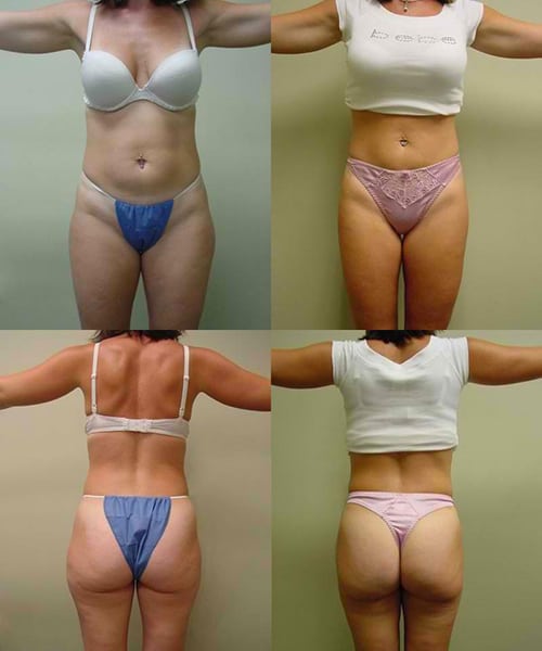 Liposuction & Body Sculpting, San Diego