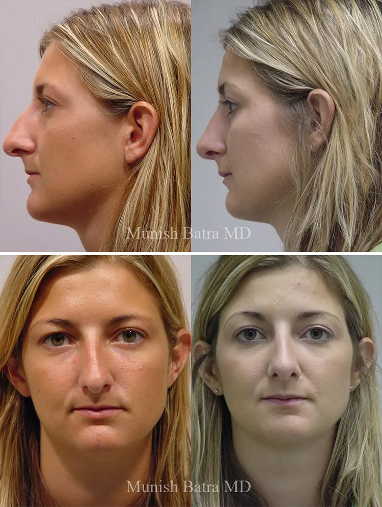 before-after