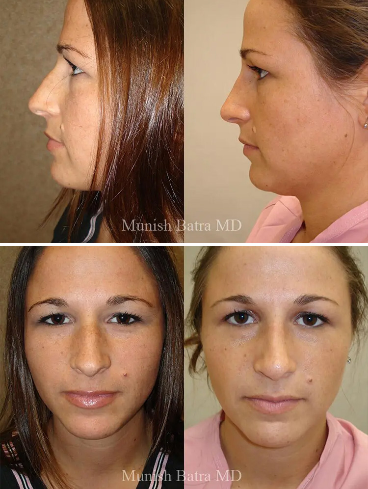 before-after-2