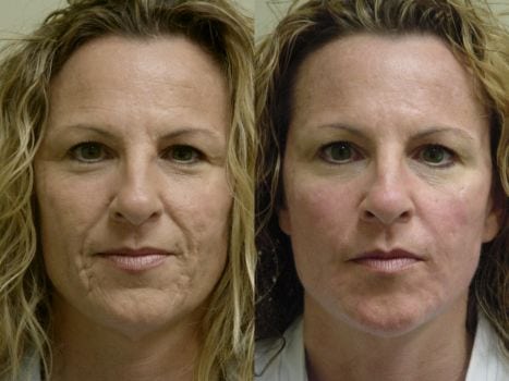 Laser Treatments in San Diego Before & After - Case Study 1