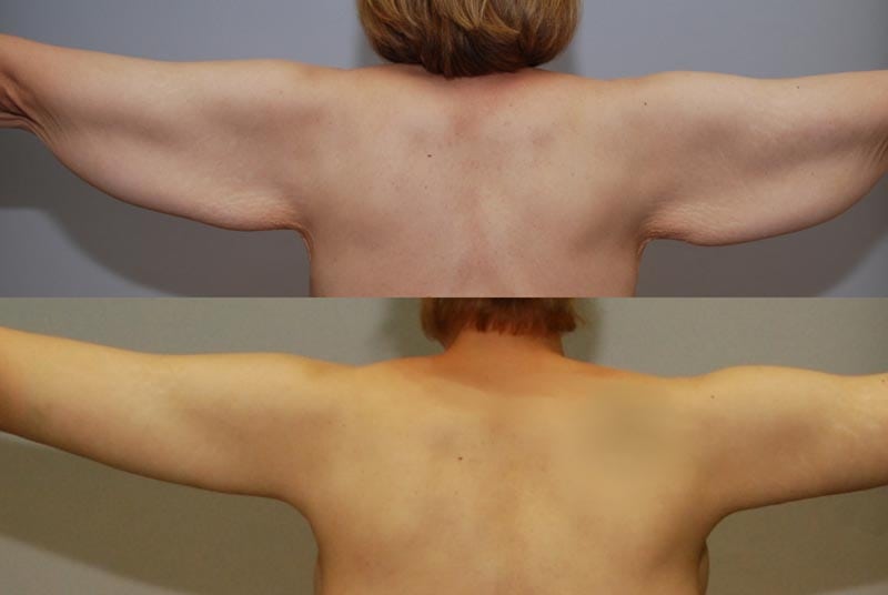 Arm Lift & Thigh Lift in San Diego Before & After - Case Study 1