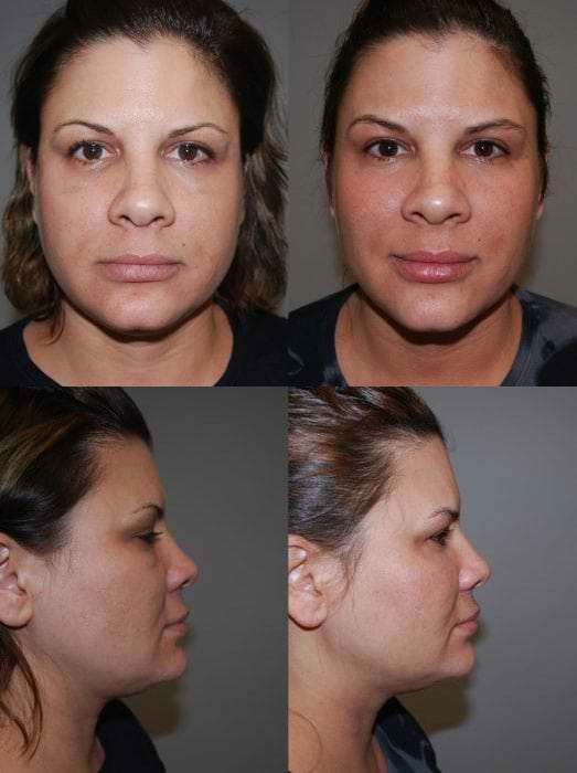 Laser Treatments in San Diego Before & After - Case Study 10