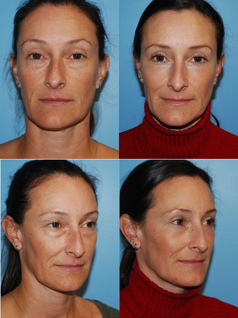 Laser Treatments in San Diego Before & After - Case Study 11