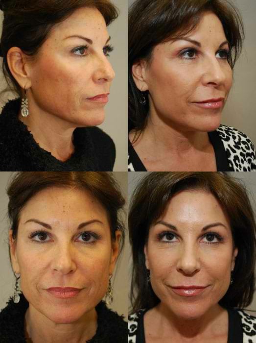 Laser Treatments in San Diego Before & After - Case Study 12