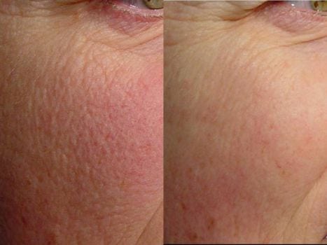 Laser Treatments in San Diego Before & After - Case Study 13