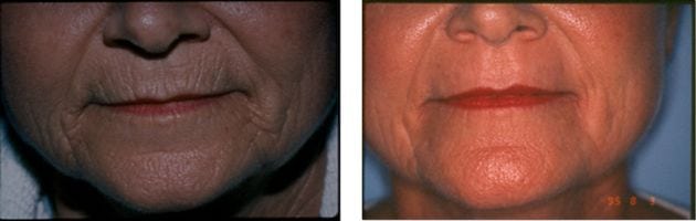 Laser Treatments in San Diego Before & After - Case Study 14