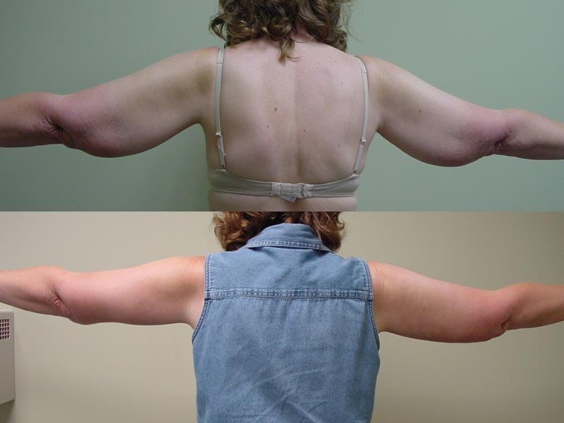 Arm Lift & Thigh Lift in San Diego Before & After - Case Study 15