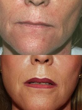 Laser Treatments in San Diego Before & After - Case Study 15