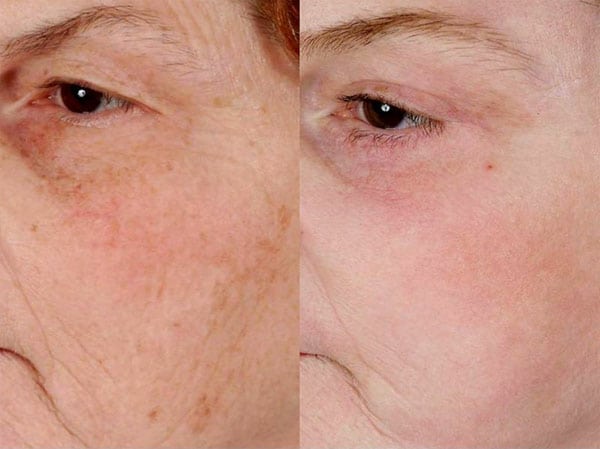 Laser Treatments in San Diego Before & After - Case Study 17