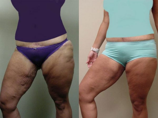 Arm Lift & Thigh Lift in San Diego Before & After - Case Study 19