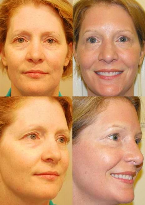 Laser Treatments in San Diego Before & After - Case Study 2