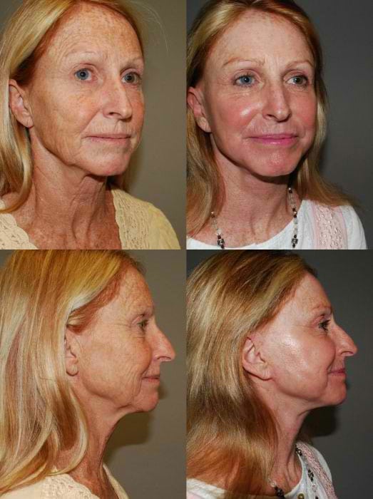 Laser Treatments in San Diego Before & After - Case Study 3