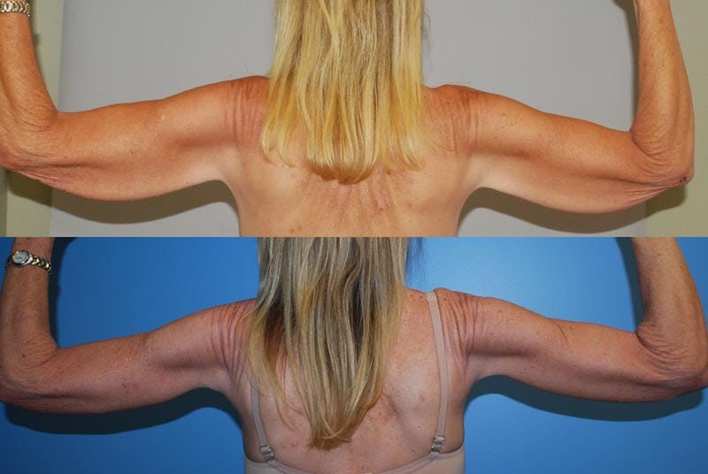 Arm Lift & Thigh Lift in San Diego Before & After - Case Study 3