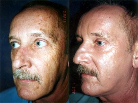 Laser Treatments in San Diego Before & After - Case Study 4