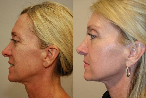 Laser Treatments in San Diego Before & After - Case Study 6