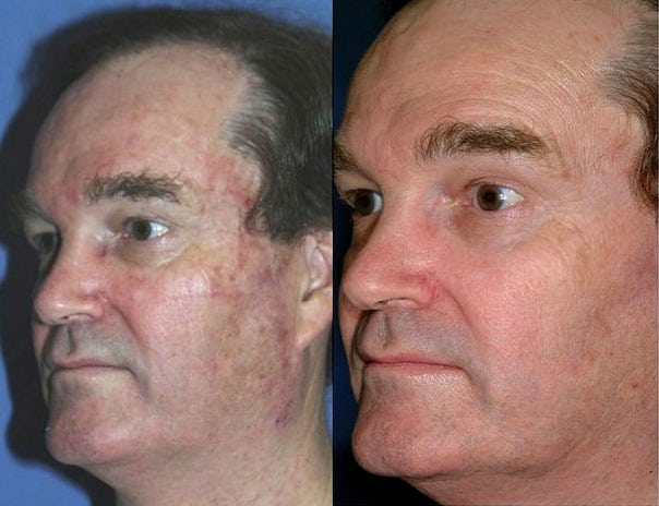 Laser Treatments in San Diego Before & After - Case Study 7