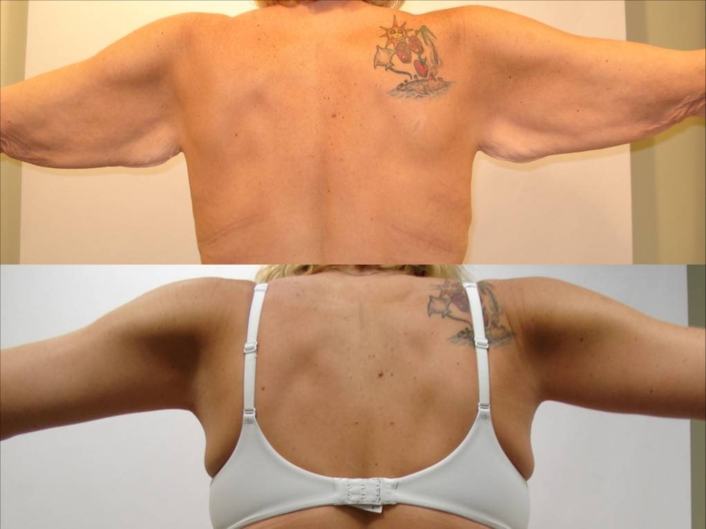 Arm Lift & Thigh Lift in San Diego Before & After - Case Study 8