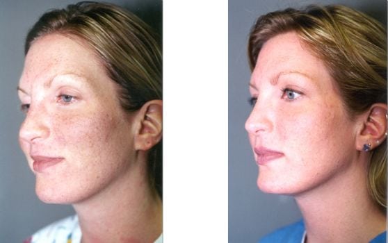 Laser Treatments in San Diego Before & After - Case Study 9