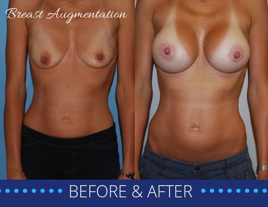 breast-augmentation-p35-35a-blog-ba-img