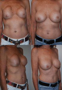 Breast Revision Coastal Plastic Surgeons PM