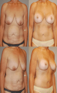 Coastal Plastic Surgeons Mommy makeover before and after photos