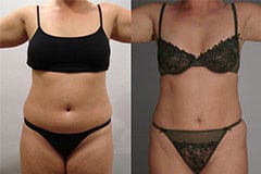 Tummy Tuck Before and After Patient