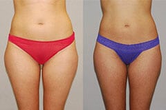 Tummy Tuck Before and After Patient 2