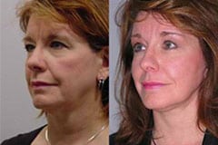 Facelift Before and After Patient