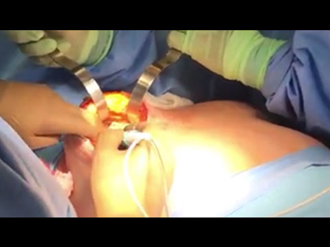 Collapsed Implant | En Bloc Resection (Part 1)