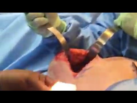 Collapsed Implant | En Bloc Resection (Part 2)