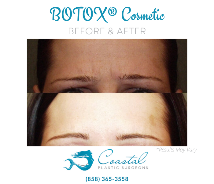 Before and after image showing the results of BOTOX® Cosmetic performed in San Diego, CA.