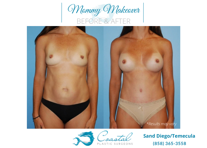Before and after image showing the results of a Mommy Makeover performed in San Deigo, CA.