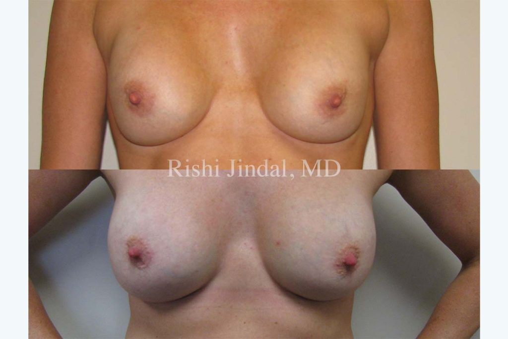 Before and after photos by Dr. Jindal, East County Coastal Plastic Surgeons