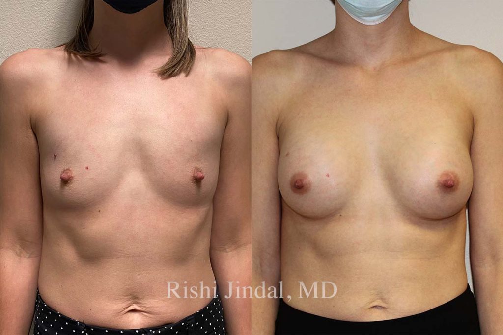 Before and after photos by Dr. Jindal, East County Coastal Plastic Surgeons
