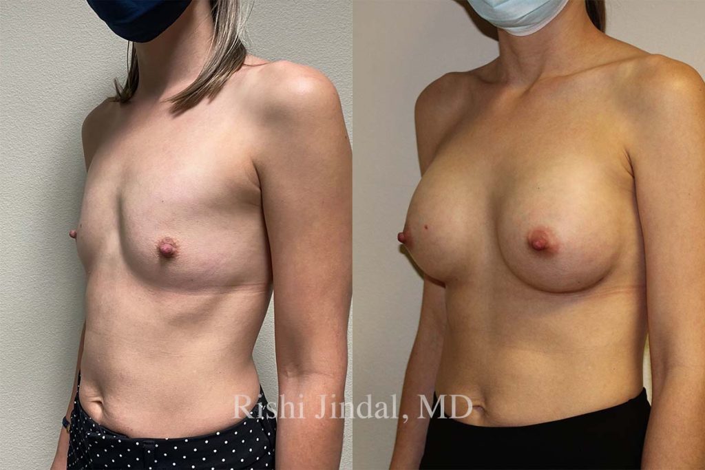 Before and after photos by Dr. Jindal, East County Coastal Plastic Surgeons