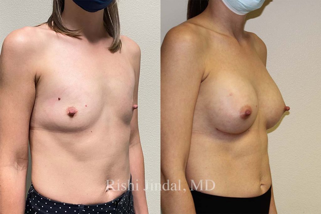 Before and after photos by Dr. Jindal, East County Coastal Plastic Surgeons
