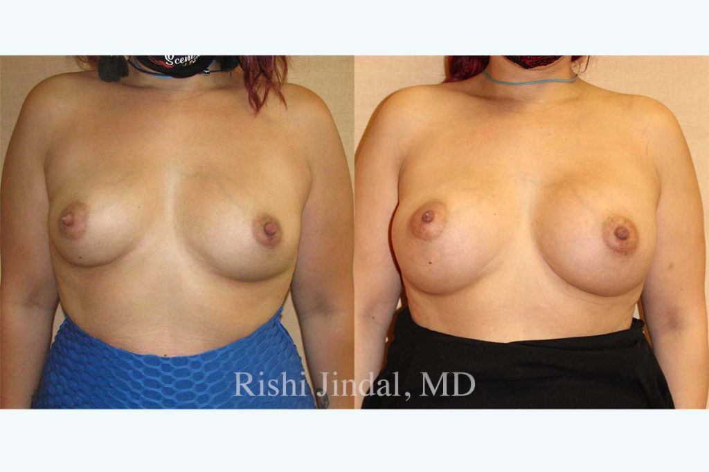Before and after photos by Dr. Jindal, East County Coastal Plastic Surgeons