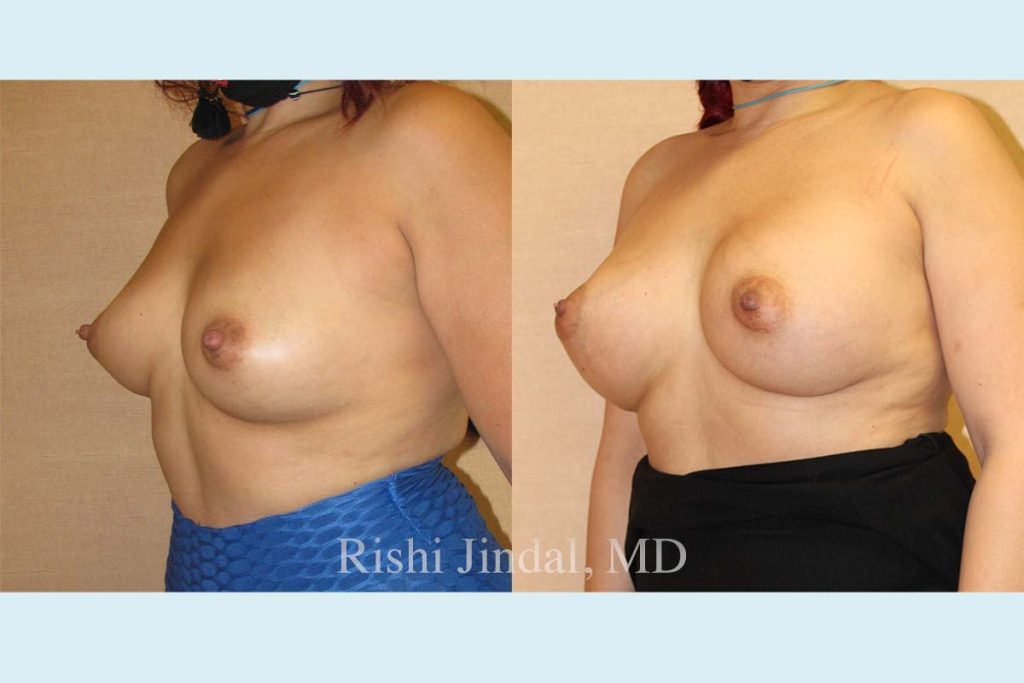 Before and after photos by Dr. Jindal, East County Coastal Plastic Surgeons
