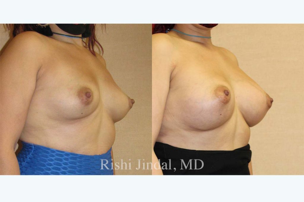 Before and after photos by Dr. Jindal, East County Coastal Plastic Surgeons