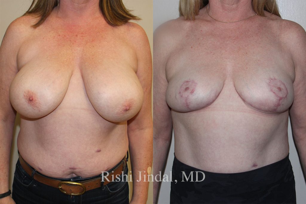 Before and after photos by Dr. Jindal, East County Coastal Plastic Surgeons