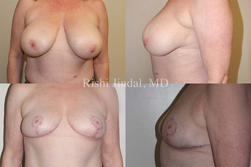 Before and after photos by Dr. Jindal, East County Coastal Plastic Surgeons