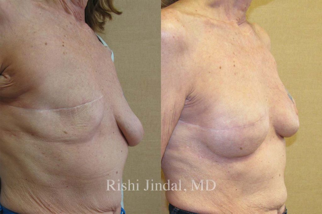 Before and after photos by Dr. Jindal, East County Coastal Plastic Surgeons