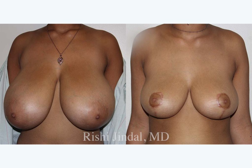 Before and after photos by Dr. Jindal, East County Coastal Plastic Surgeons