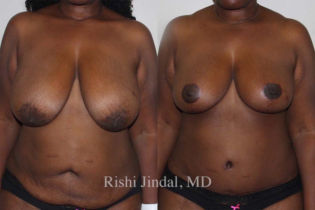 Before and after photos by Dr. Jindal, East County Coastal Plastic Surgeons