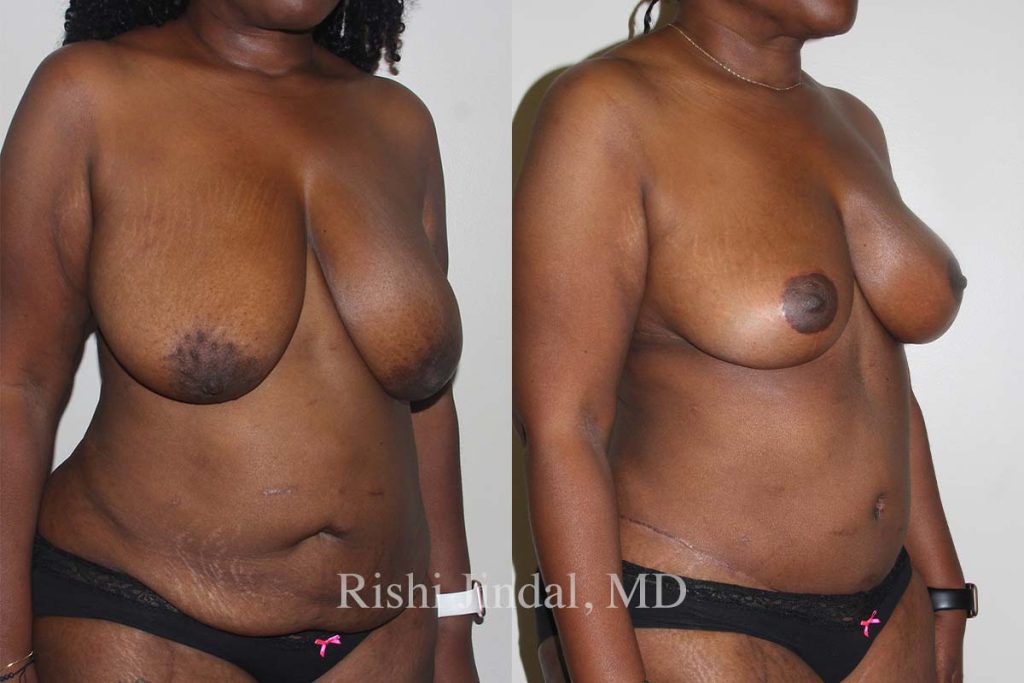 Before and after photos by Dr. Jindal, East County Coastal Plastic Surgeons
