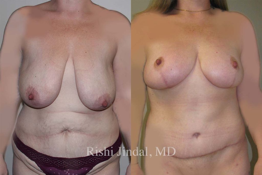 Before and after photos by Dr. Jindal, East County Coastal Plastic Surgeons