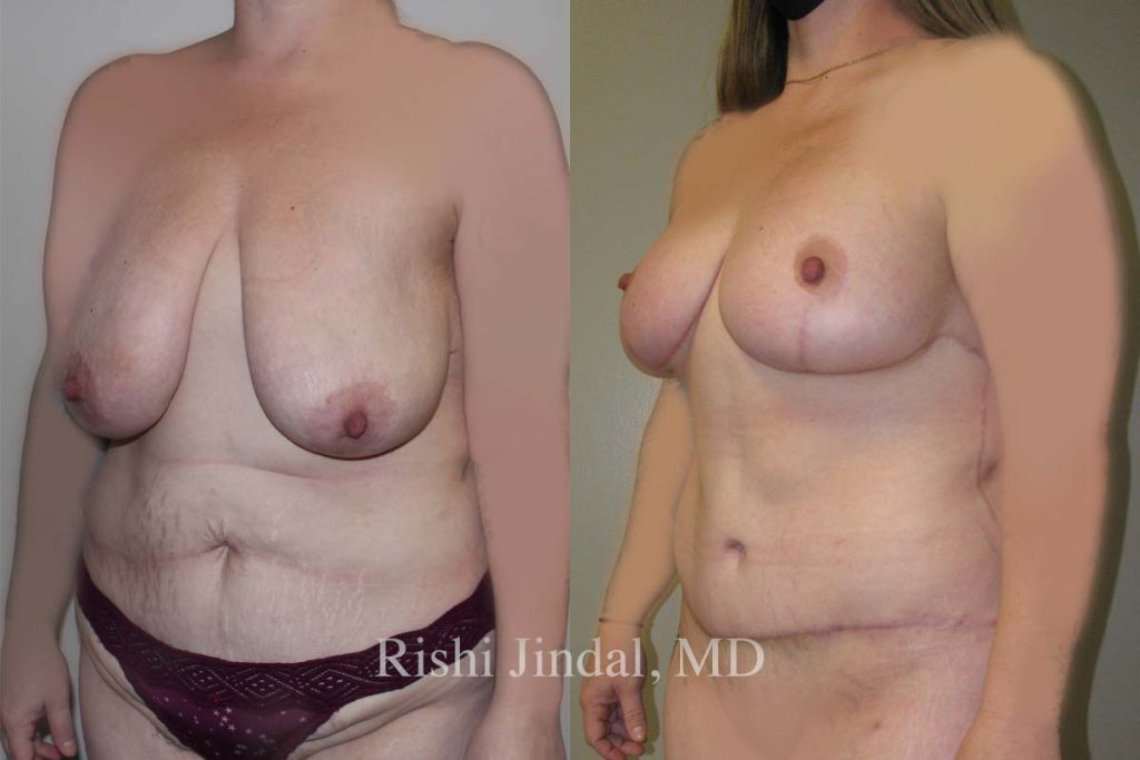 Before and after photos by Dr. Jindal, East County Coastal Plastic Surgeons
