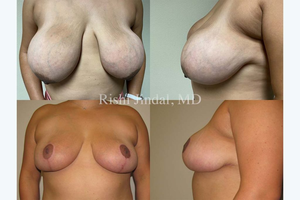 Before and after photos by Dr. Jindal, East County Coastal Plastic Surgeons