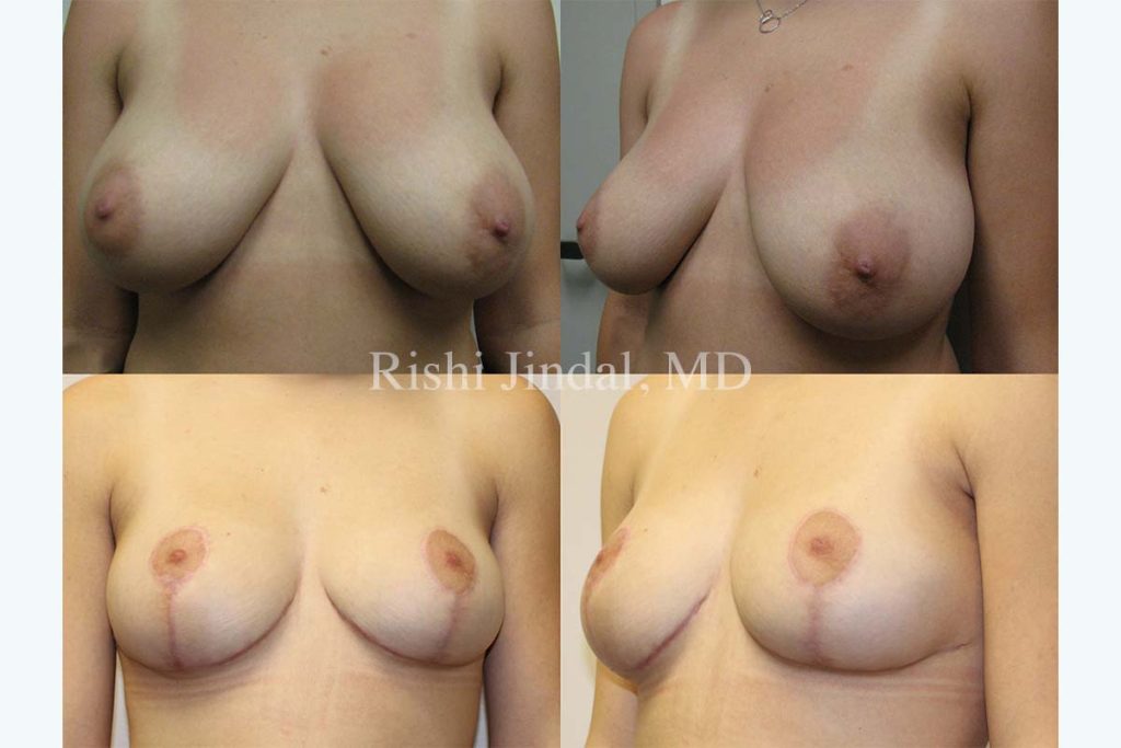 Before and after photos by Dr. Jindal, East County Coastal Plastic Surgeons