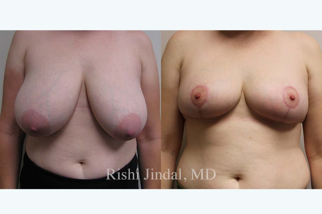 Before and after photos by Dr. Jindal, East County Coastal Plastic Surgeons